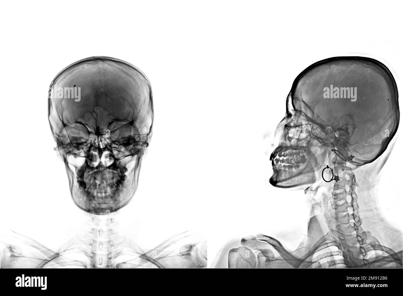 raggio x del cranio isolato su sfondo bianco Foto Stock