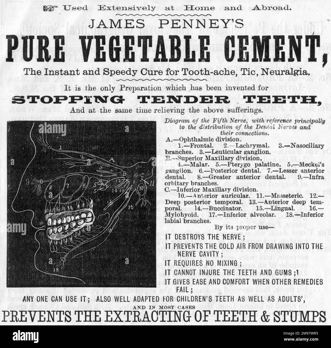 Pubblicità dentale, il cemento vegetale puro di James Penney, per fermare i denti teneri. Foto Stock