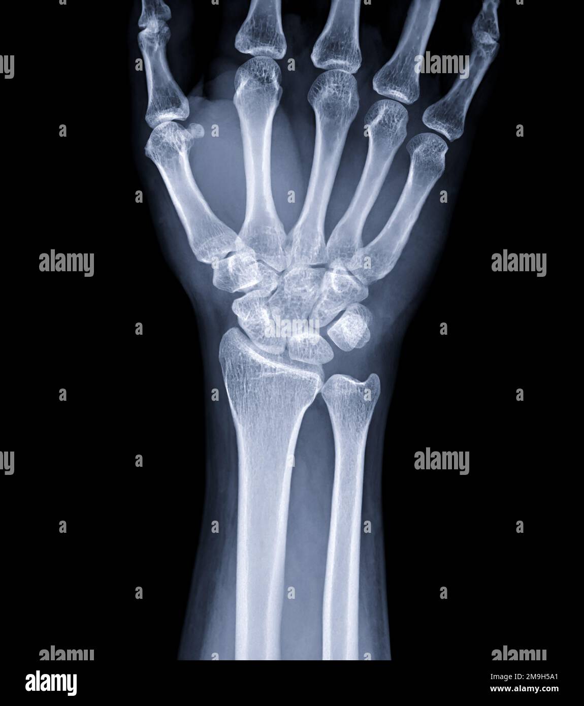 Immagine radiografica dell'articolazione del polso per la diagnosi dell'artrite reumatoide . Foto Stock