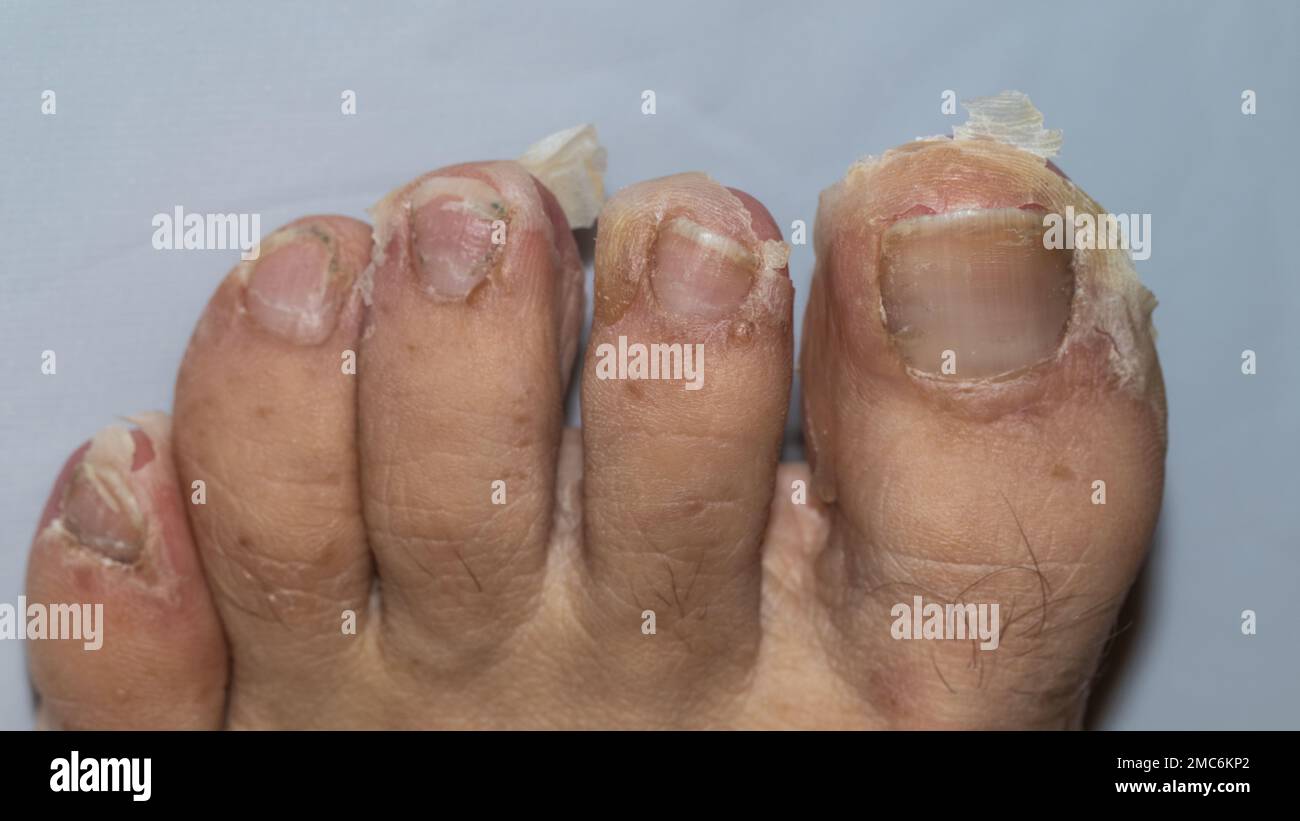 dettaglio dell'esfoliazione dopo la scarlattina in una persona caucasica adulta Foto Stock