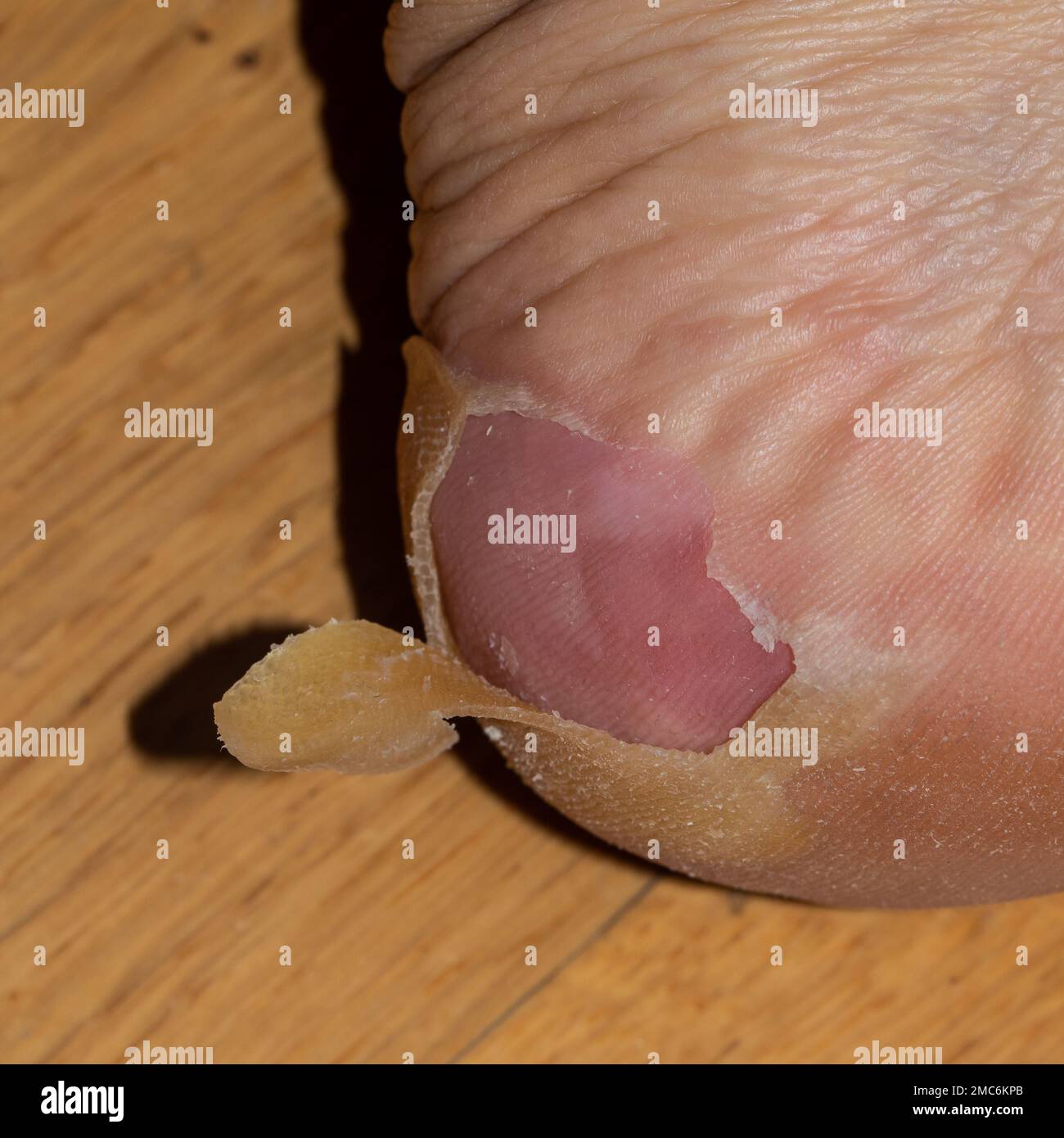 dettaglio dell'esfoliazione dopo la scarlattina in una persona caucasica adulta Foto Stock