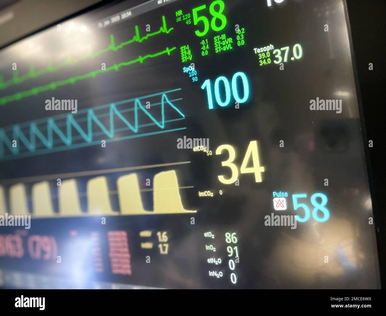 Monitor ospedalieri elettrocardiogramma pulsazioni apparecchi chirurgici per anestesia Foto Stock
