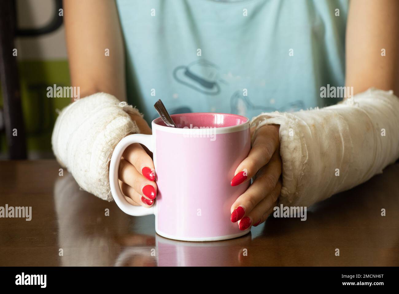 una ragazza con due braccia rotte in un cast tiene una tazza di tè in cucina per la prima colazione, braccia rotte in un cast, arti fratturate, lesioni Foto Stock