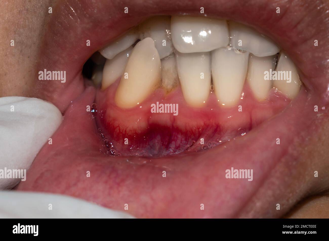 Infiammazione delle gengive chiamata gengivite. Problema parodontale. Scarsa igiene orale. Foto Stock