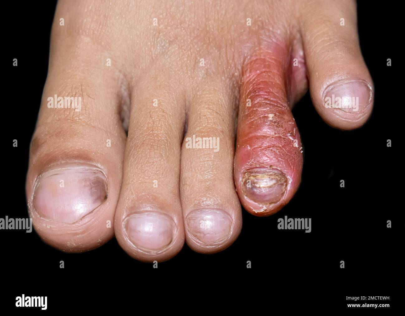 micosi-superficiale-immagini-e-fotografie-stock-ad-alta-risoluzione-alamy