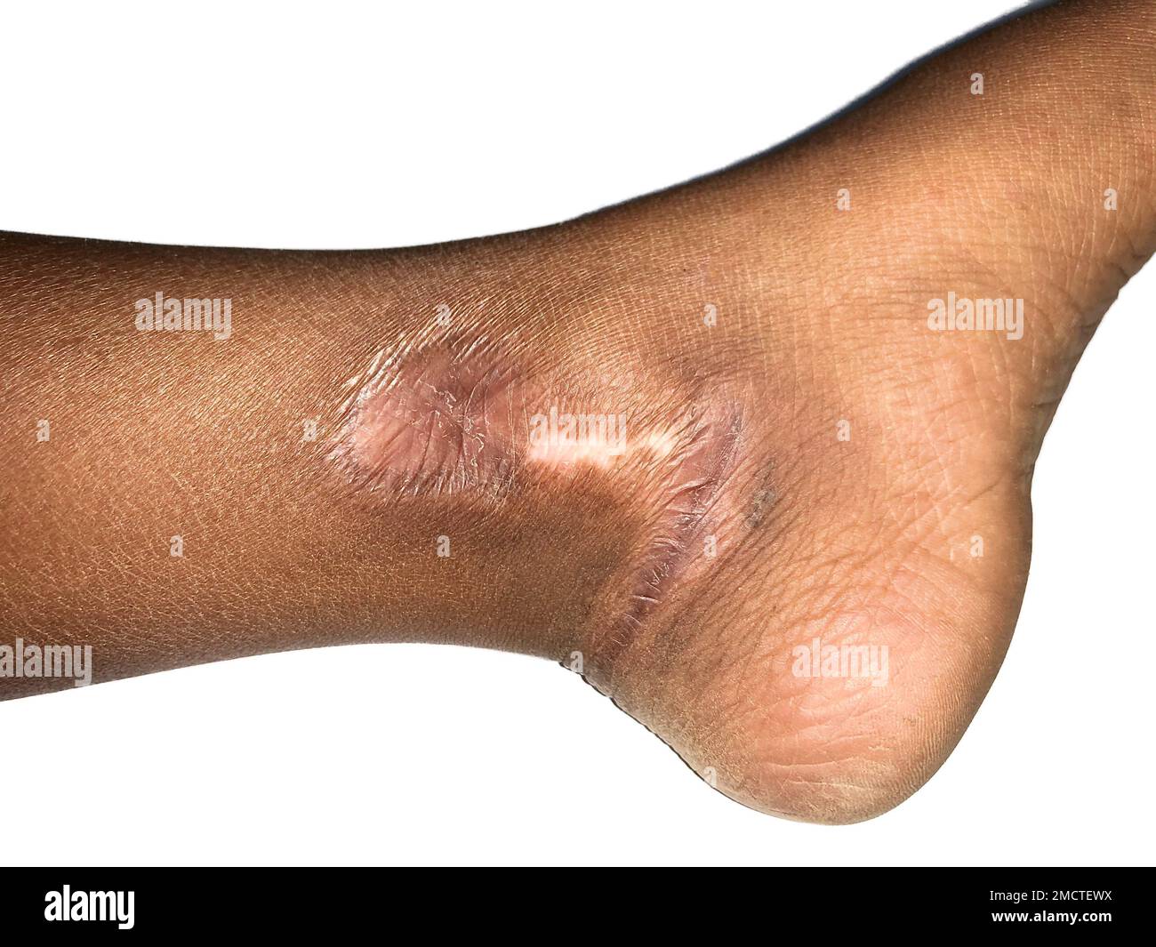 Cicatrice ipertrofica alla gamba del bambino asiatico. Isolato su bianco. Foto Stock