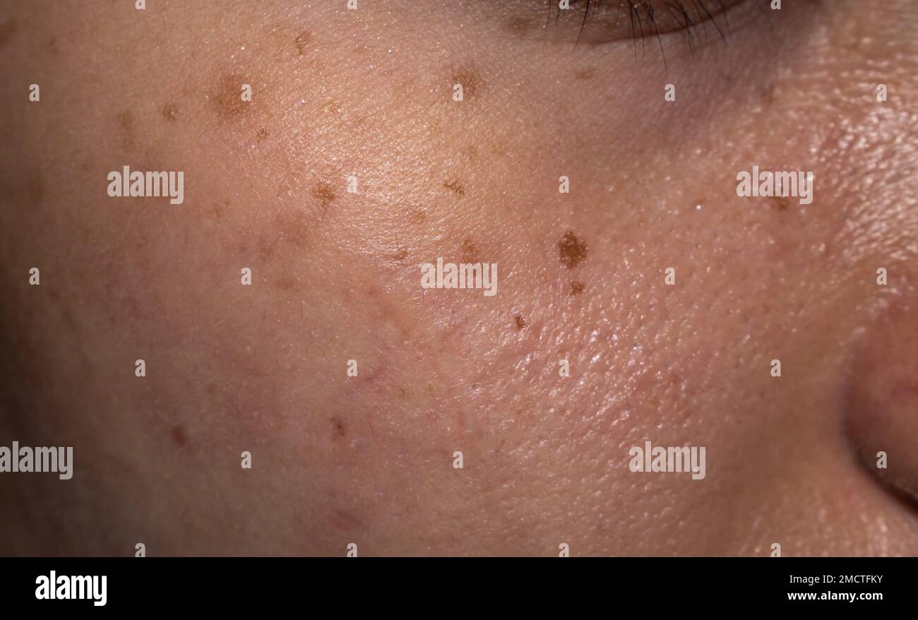 Lentiggini e macchie marroni sulla faccia oleosa della giovane donna asiatica. Foto Stock