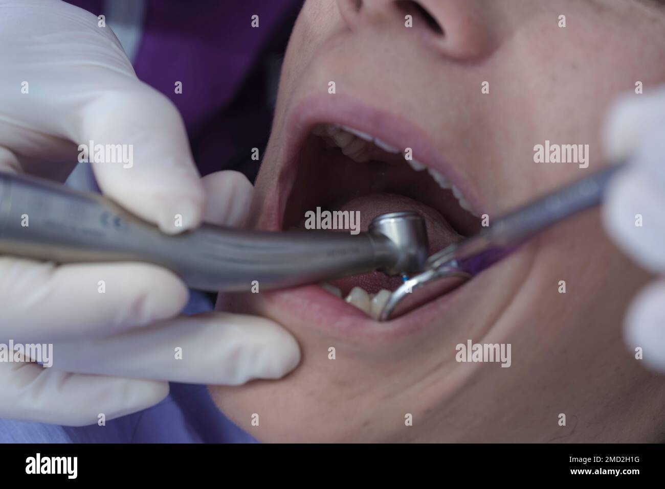 Una giovane donna con la bocca aperta al dentista, che usa lo specchio e una sonda per fare una diagnosi. Il dentista usa i guanti per evitare la malattia Foto Stock
