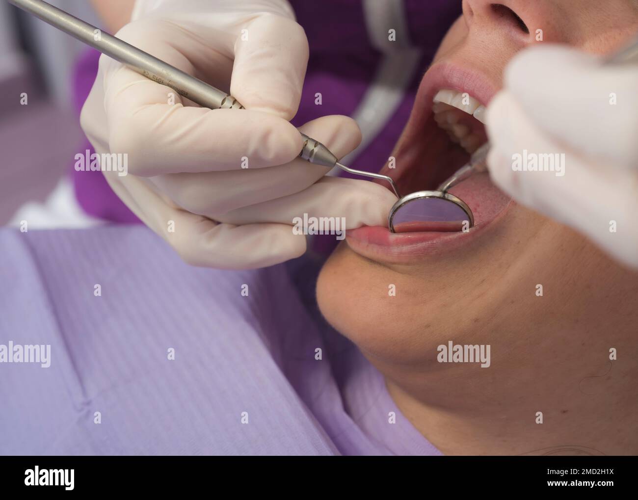 Una giovane donna con una bocca aperta al dentista, che utilizza lo specchio e una sonda per fare una diagnosi - un visibile decadimento dentale Foto Stock