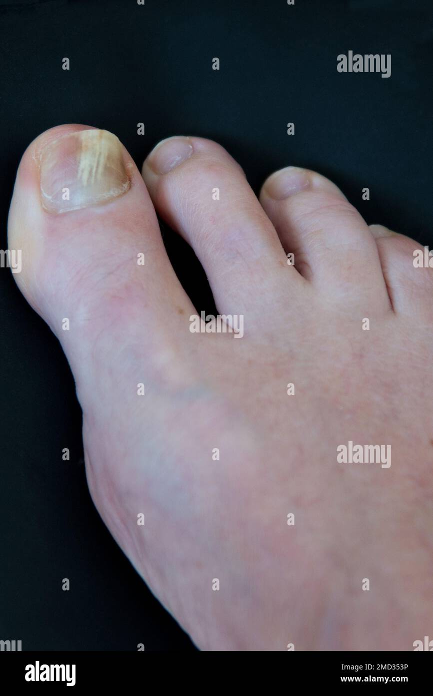 Primo piano di un dito del piede con fungo delle unghie, causando ispessimento delle unghie e scolorimento. Il fungo dell'unghia è anche chiamato onicomicosi Foto Stock