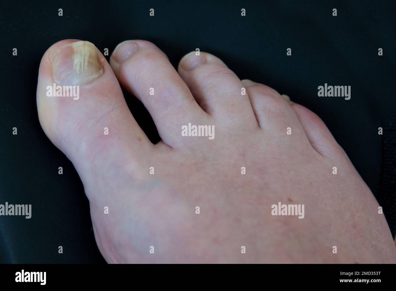 Primo piano di un dito del piede con fungo delle unghie, causando ispessimento delle unghie e scolorimento. Il fungo dell'unghia è anche chiamato onicomicosi Foto Stock