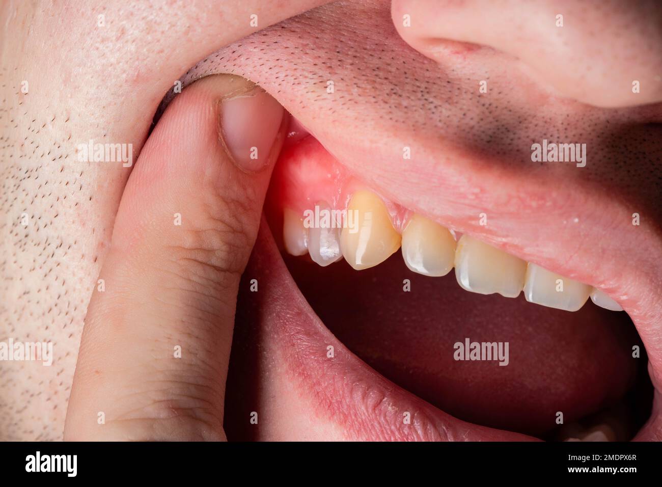 Gengive rosse e gonfie in un uomo. Gengivite malattia gengivite, gumboil e  infiammazione Foto stock - Alamy