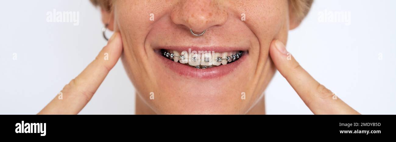 Donna con sorriso di salute che mostra denti bianchi con bretelle dentali. Foto Stock
