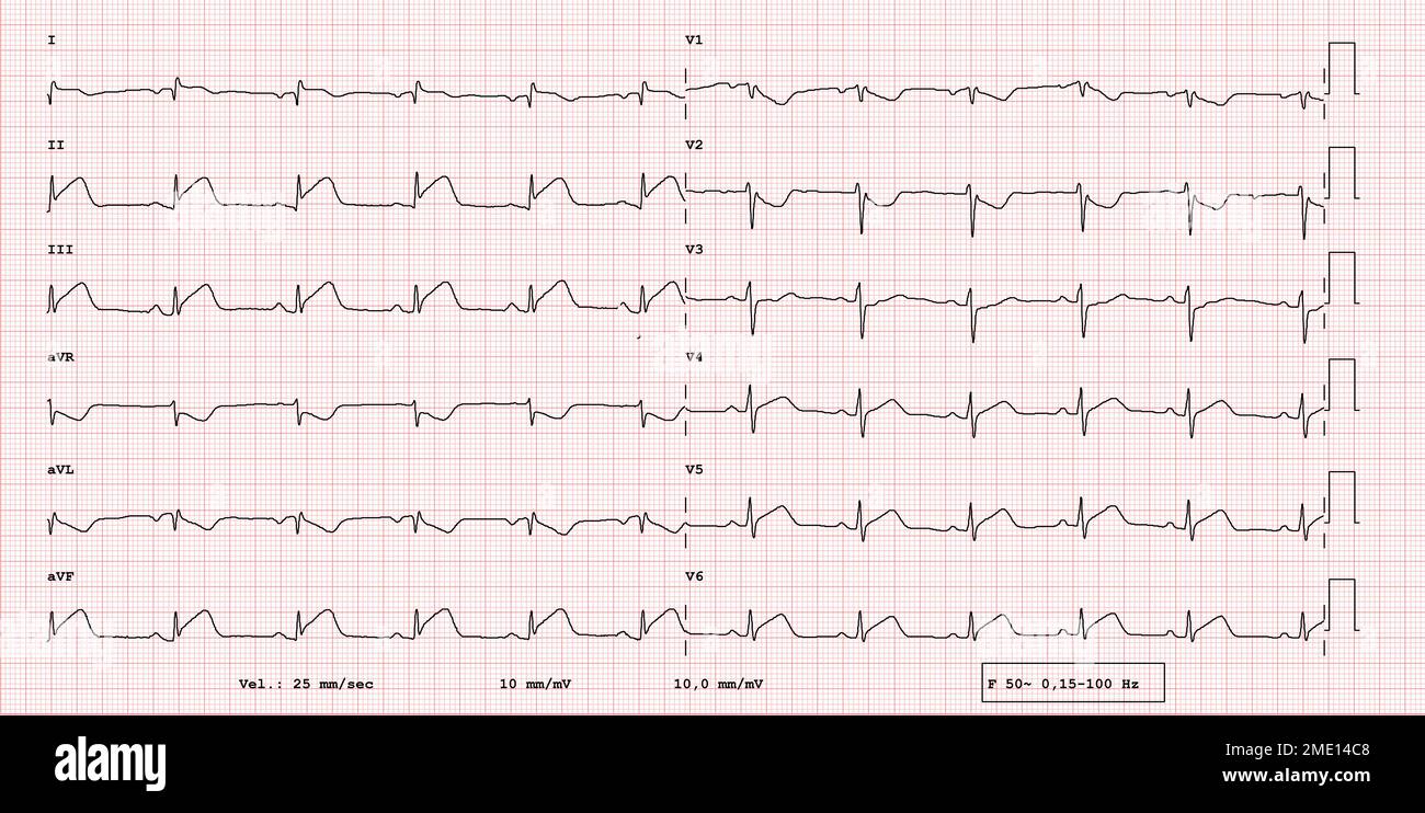 Esempio ECG di ritmo a 12 derivazioni, infarto miocardico acuto, esame reale Foto Stock