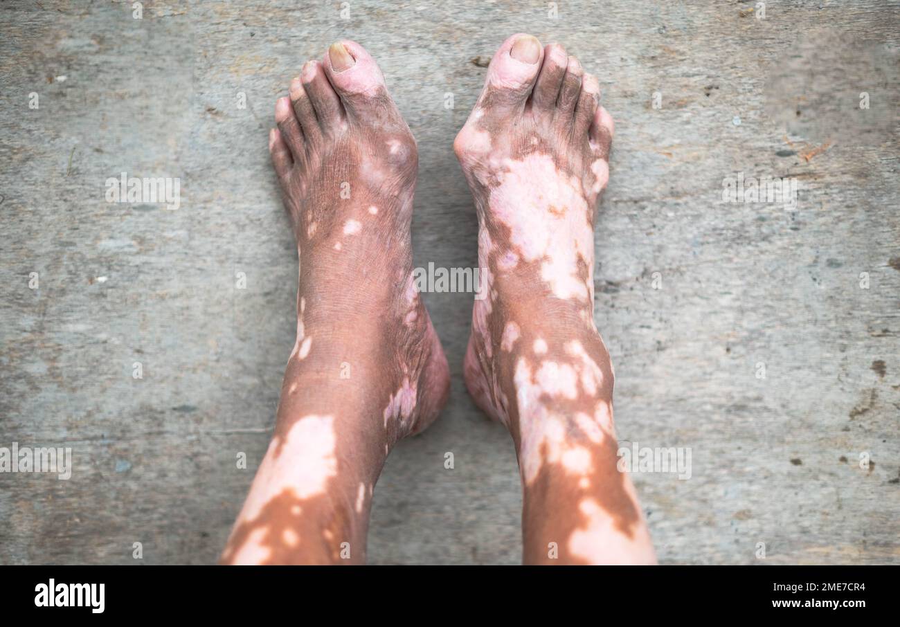 La gamba del vecchio con la condizione della pelle che causa la perdita di melanina in posa all'interno. Il modello di piede in nero canotta top che soffre di malattia vitiligine. Foto Stock