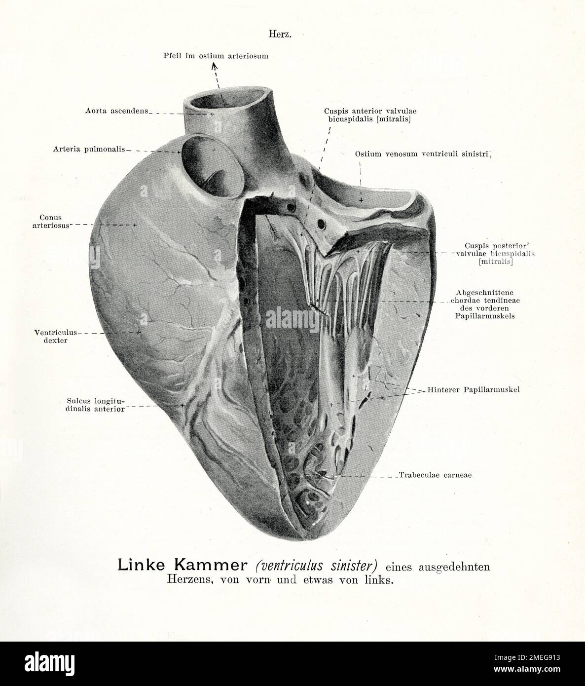 Illustrazione vintage dell'anatomia del ventricolo sinistro di un cuore dilatato, vista frontale e parziale sinistra con descrizioni anatomiche tedesche Foto Stock