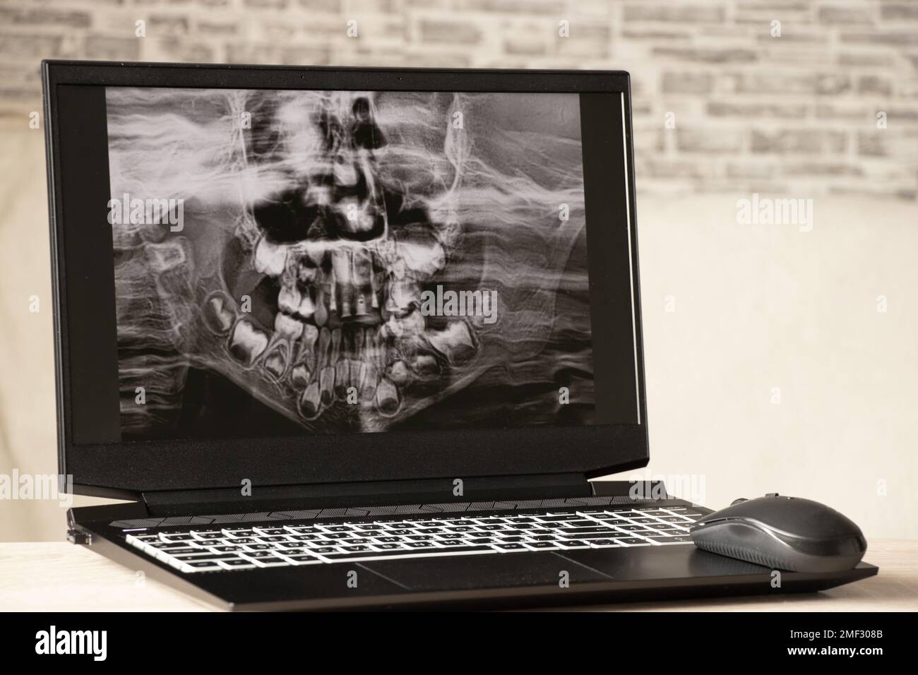 Raggi X panoramici dei denti dei bambini di due mascelle, ortopantomogramma dei denti dei bambini sugli schermi dei computer portatili sul tavolo Foto Stock