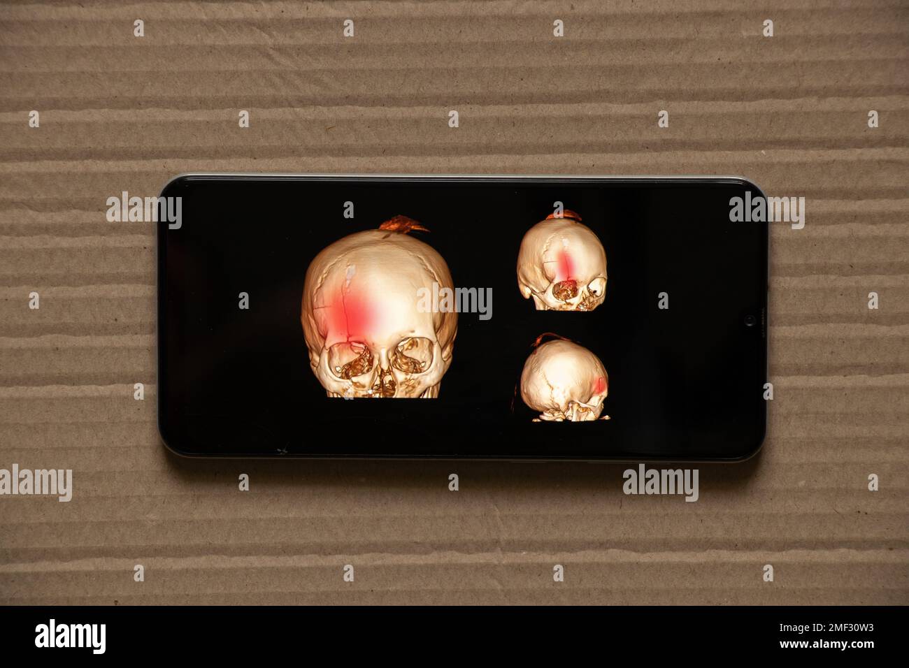 3D tomografia computerizzata del cervello con una frattura della parte frontale del cranio dopo lesione sugli schermi del telefono, applicazione mobile Foto Stock