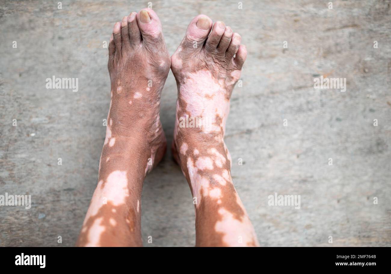 La gamba del vecchio con la condizione della pelle che causa la perdita di melanina in posa all'interno. Il modello di piede in nero canotta top che soffre di malattia vitiligine. Foto Stock