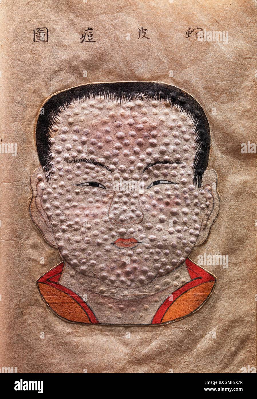 Vaiolo, illustrazione del 18th° secolo Foto Stock