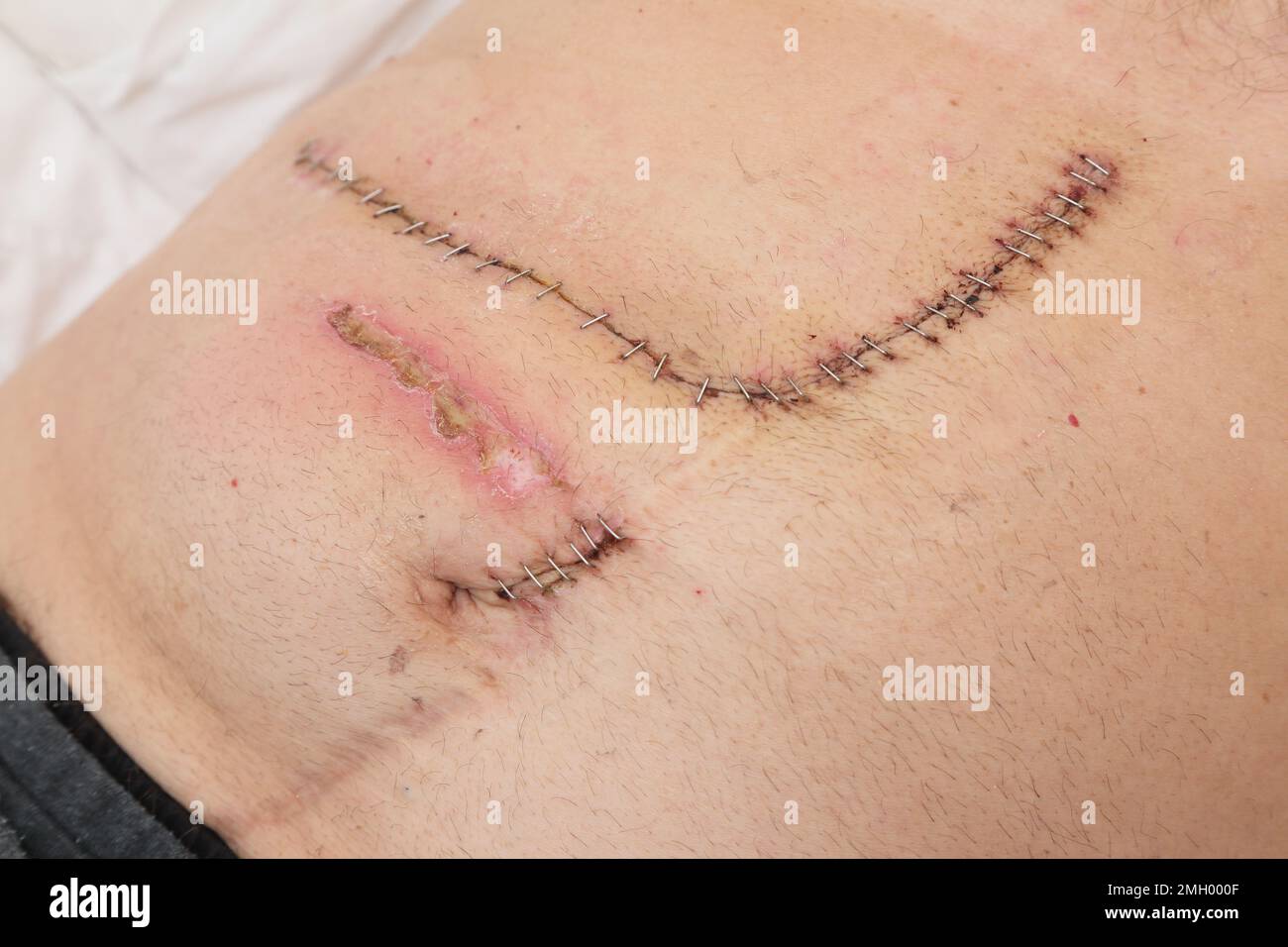 Primo piano delle graffette chirurgiche utilizzate per chiudere l'incisione dopo l'intervento chirurgico addominale e dolore da bendaggi pelle irritante Foto Stock