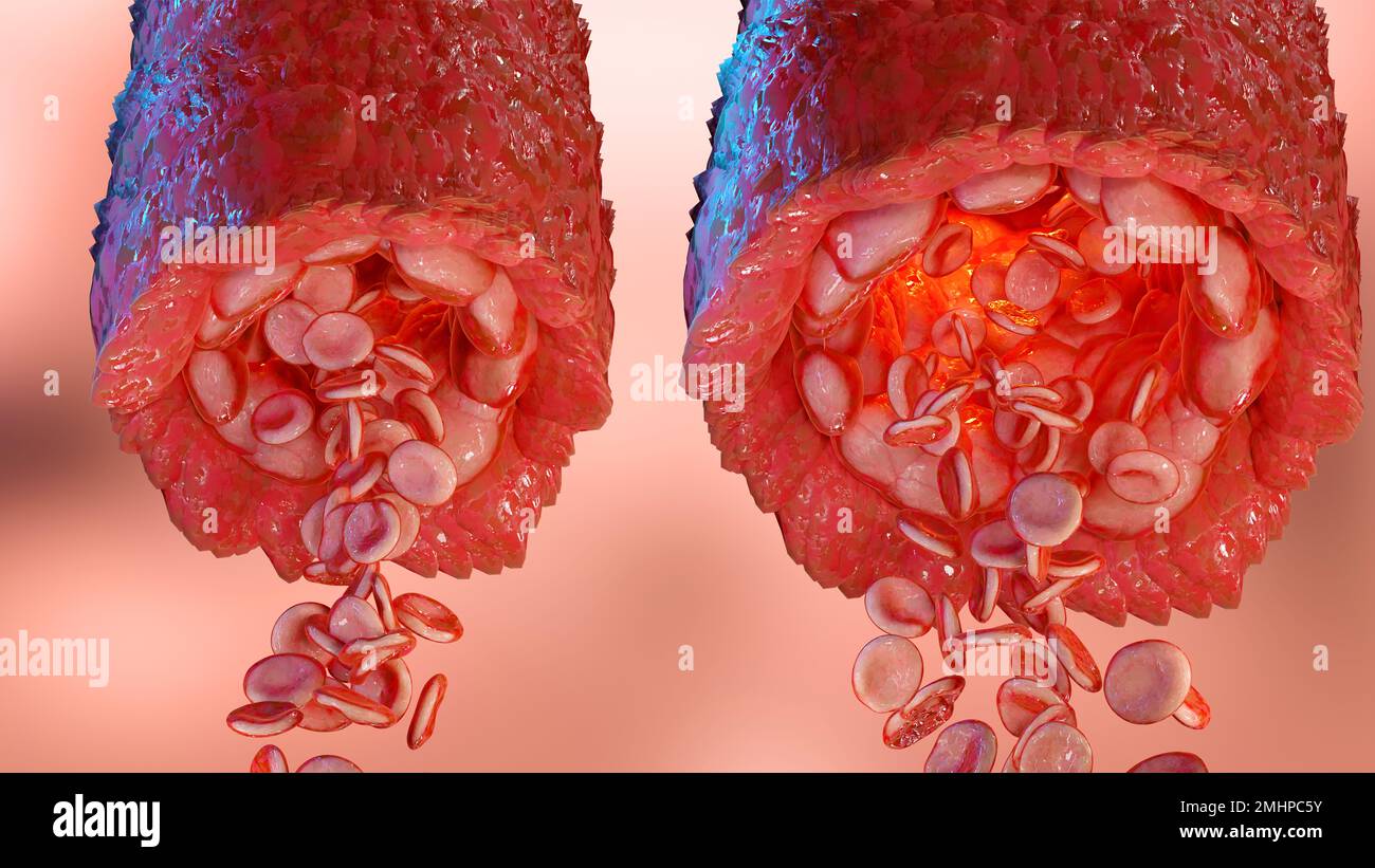 Arteria Dei Vasi Sanguigni Bloccati Con Cellule Di Accumulo Di - Foto 2