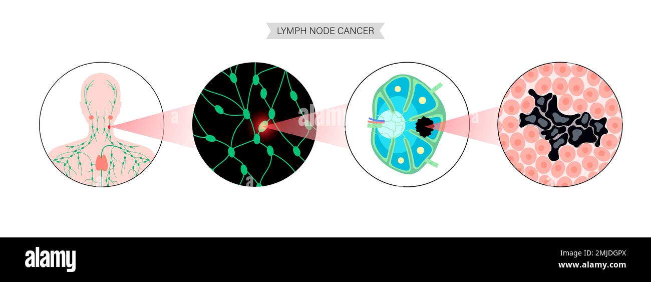 Linfoma, illustrazione concettuale Foto Stock