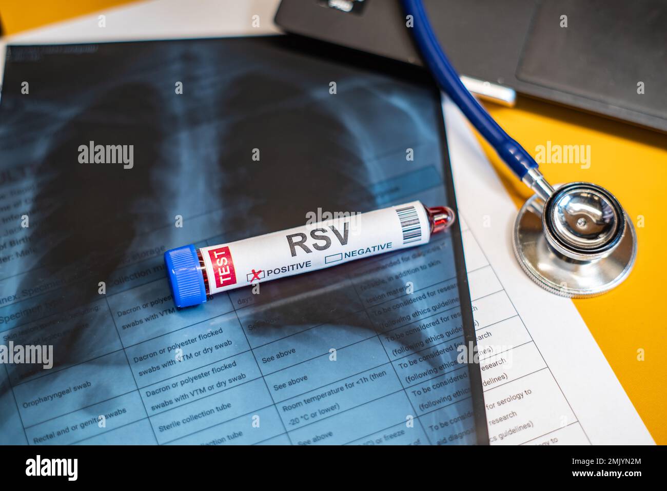 Provette per il prelievo ematico risultati positivi del test del virus respiratorio sinciziale (RSV), concetto medico Foto Stock