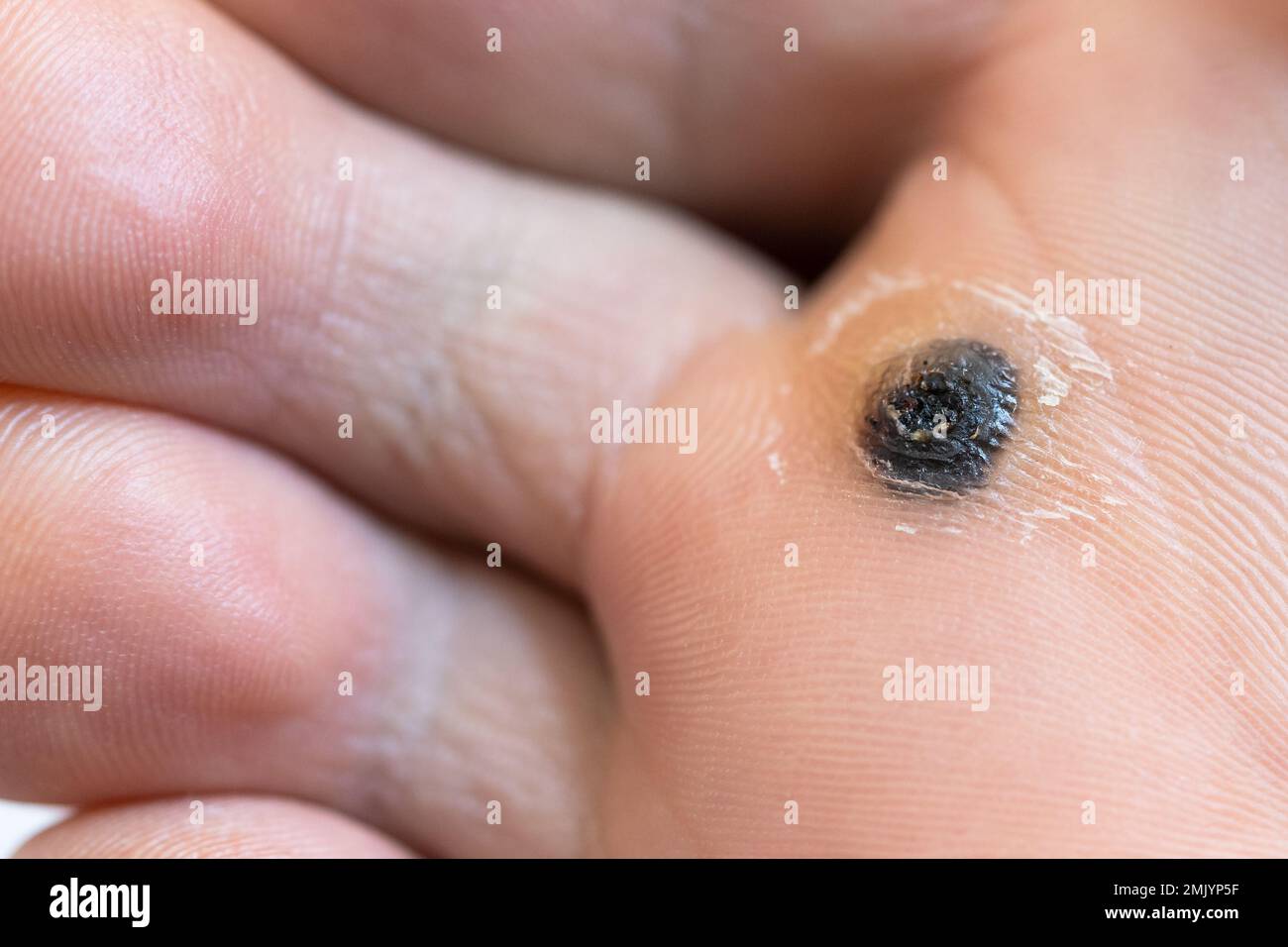 Closeup di verruca plantare dopo cauterizing esso con celandina sul piede infetto. Papillomavirus o HPV Foto Stock