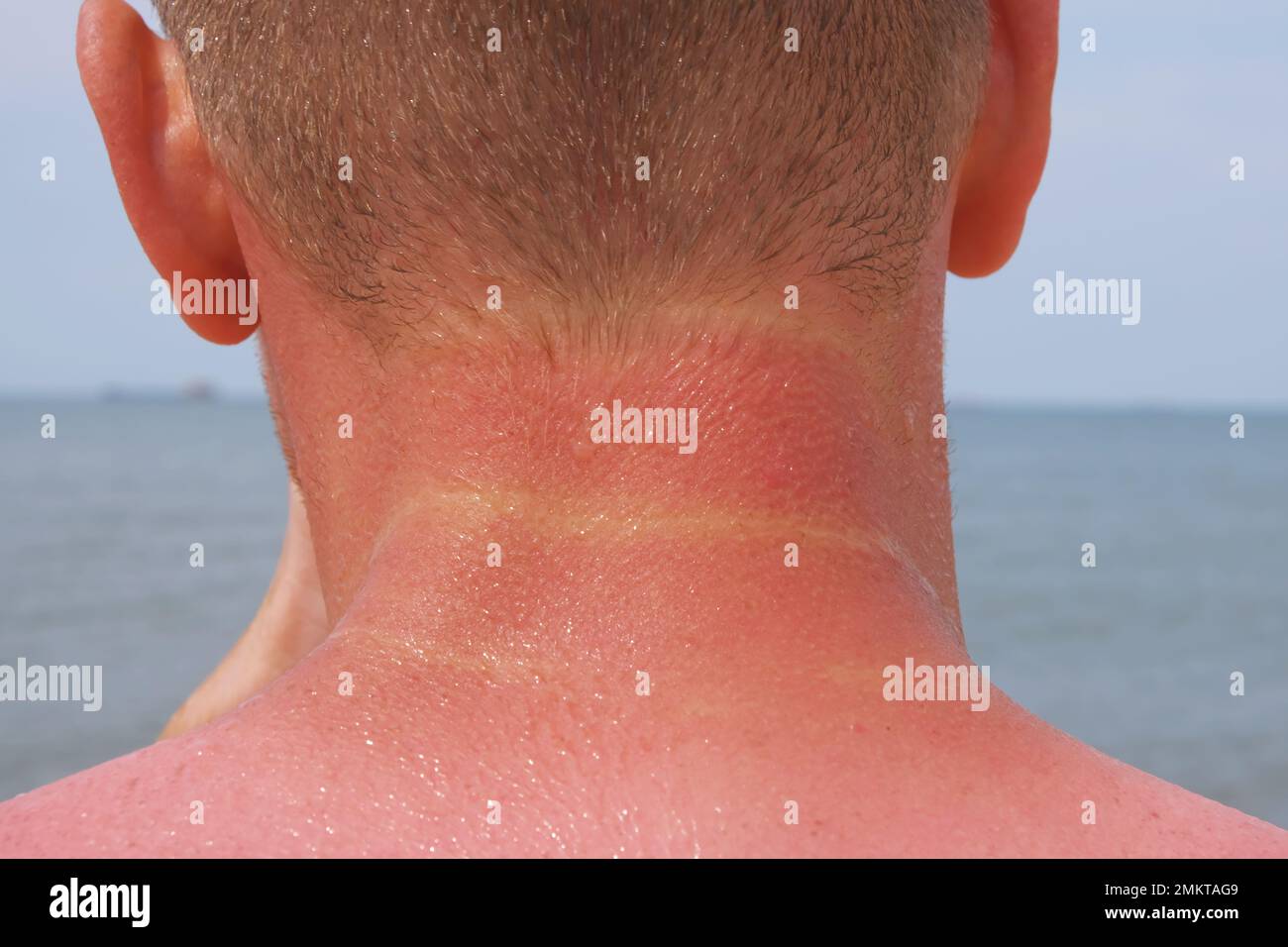 L'uomo ricevette scottature sulla riva del mare. La pelle si spellerà. Protezione della pelle dal sole. Foto Stock