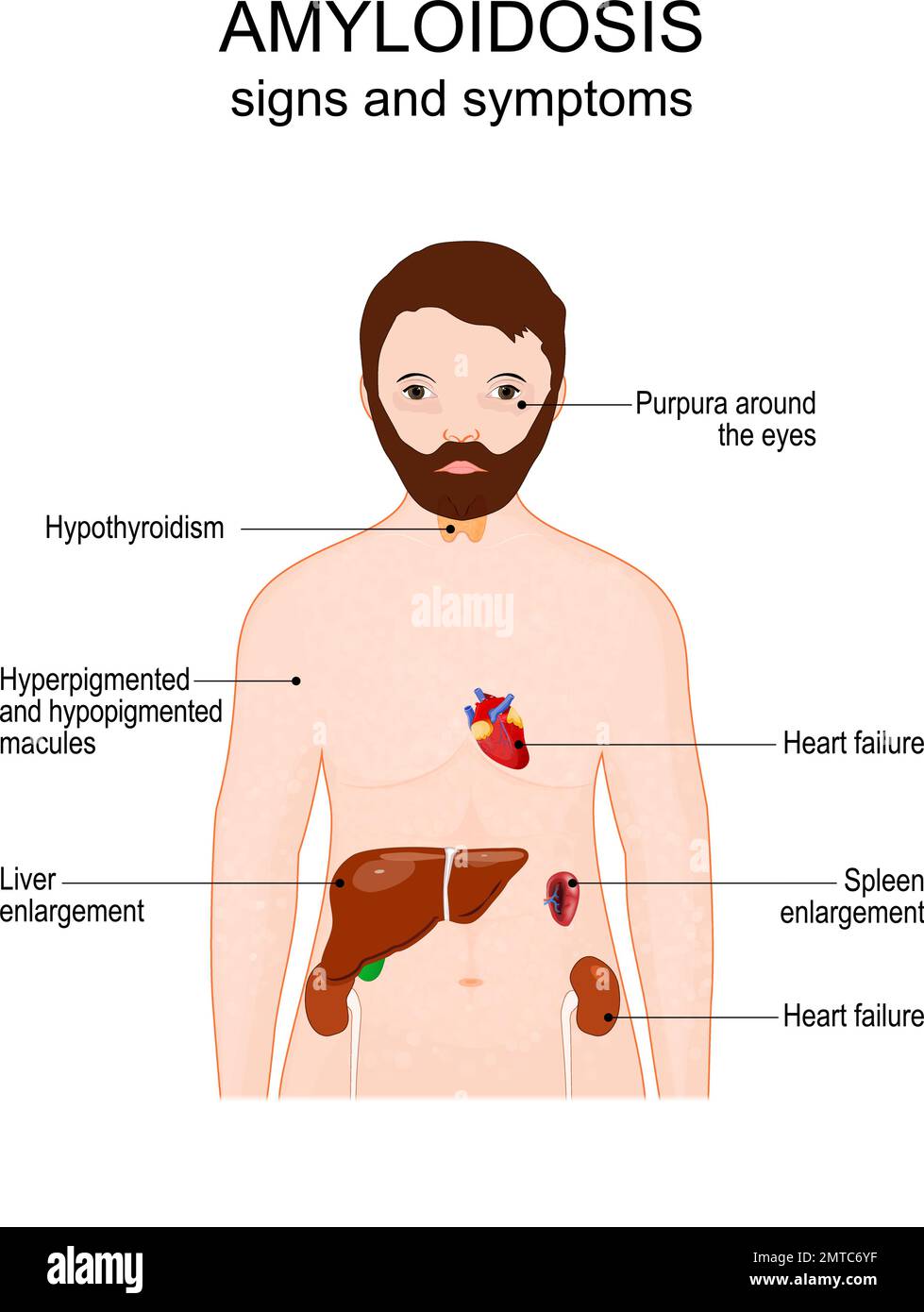 Amiloidosi. Segni e sintomi. Corpo umano con porpora intorno agli occhi, rash cutaneo, fegato, reni, ghiandola tiroidea, cuore e milza. Poster vettoriale Illustrazione Vettoriale