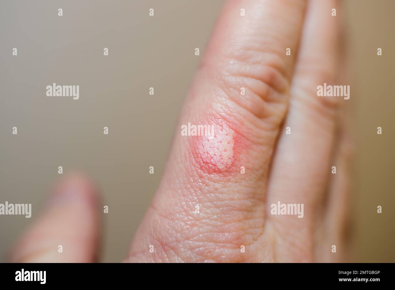 Pelle bruciata su un dito di mano di uomo caucasico - cerotto di pelle bruciata rosso Foto Stock