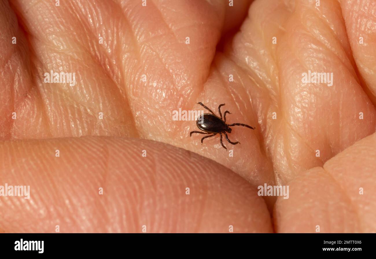 Encefalite infettiva Ixodes Scapularis o Persulcatus Deer Tick Insect sulla pelle. Encefalite virus o malattia di Lyme borreliosi infetta Ixodes Tick Foto Stock