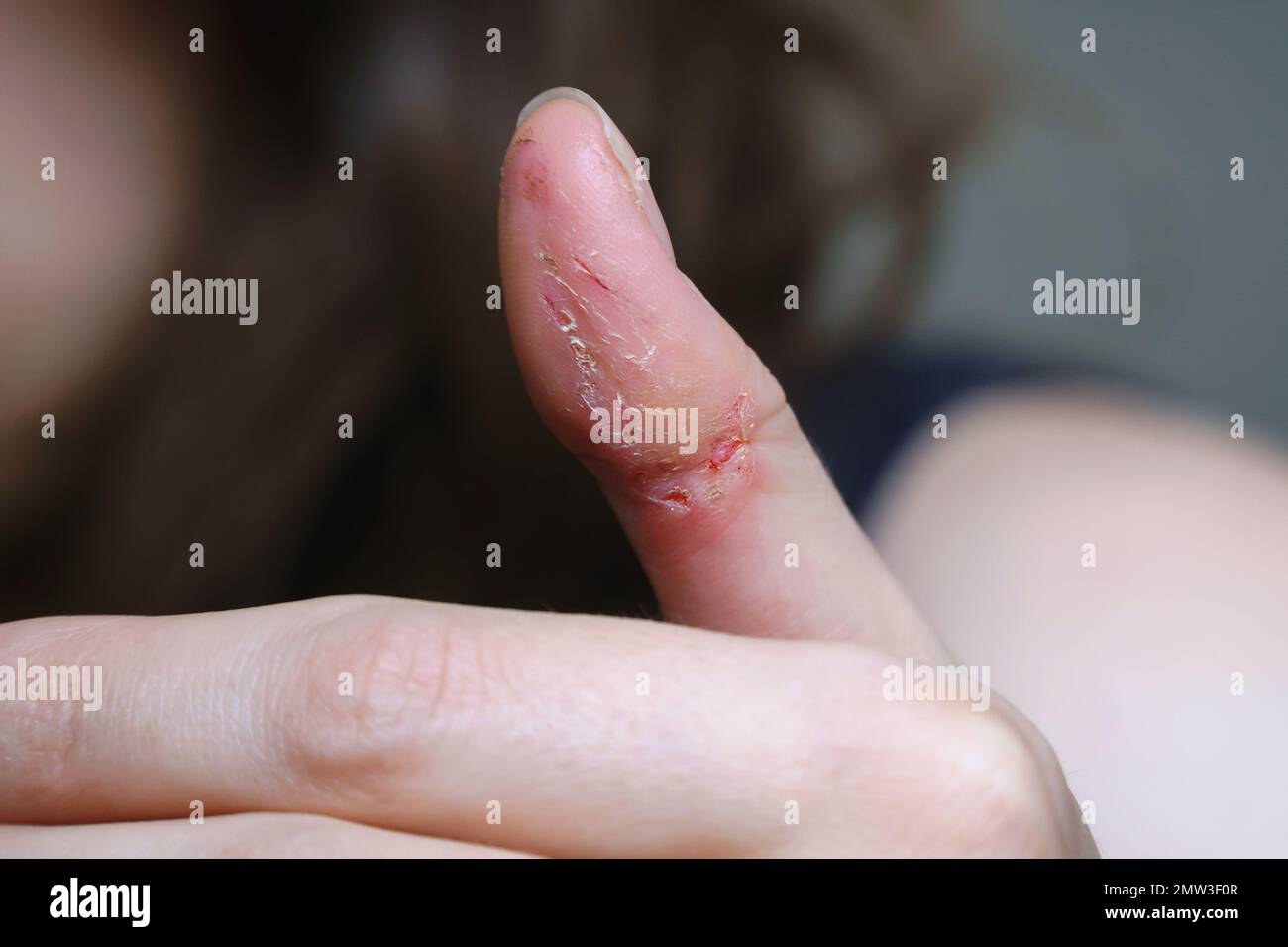 Foto realistica del danno della pelle da mordere le dita durante l'ansia Foto Stock