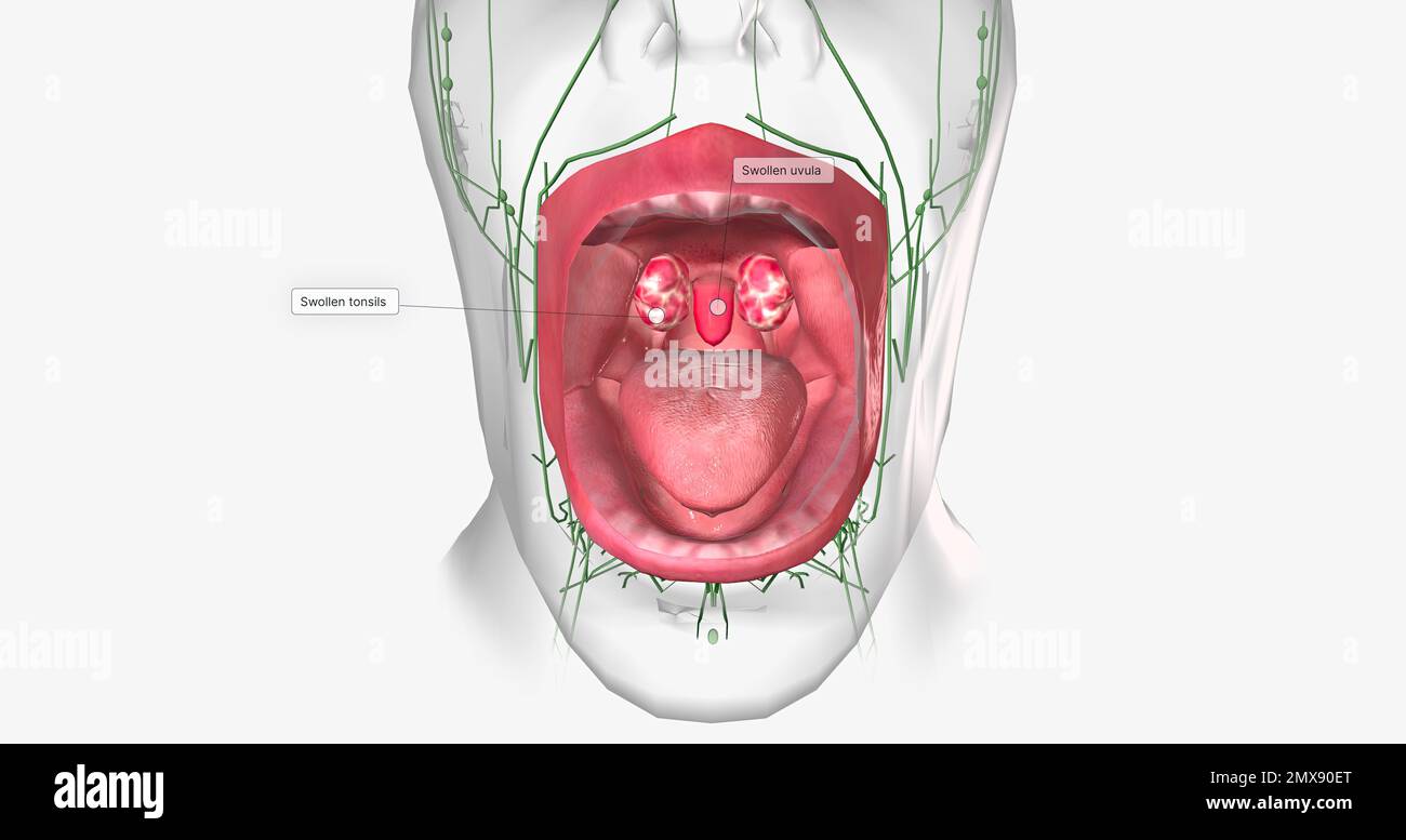 La gola dello streptococco è una condizione comune causata da un'infezione  batterica della bocca e della parte posteriore del cavo orale. 3D rendering  Foto stock - Alamy