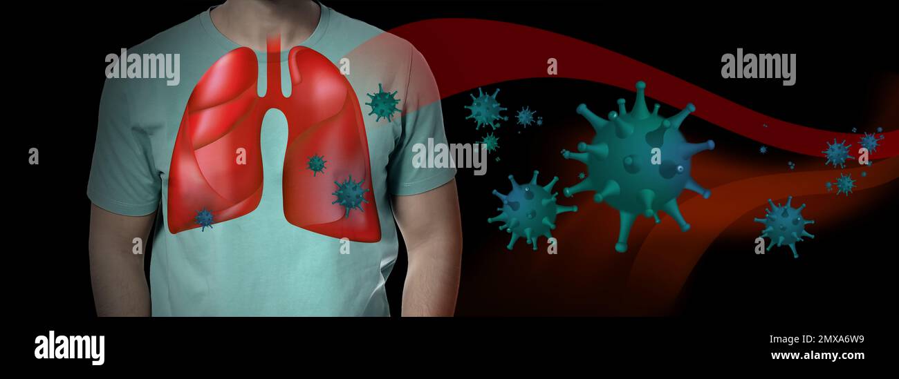 Uomo con polmoni malati e virus intorno a lui su sfondo scuro Foto Stock