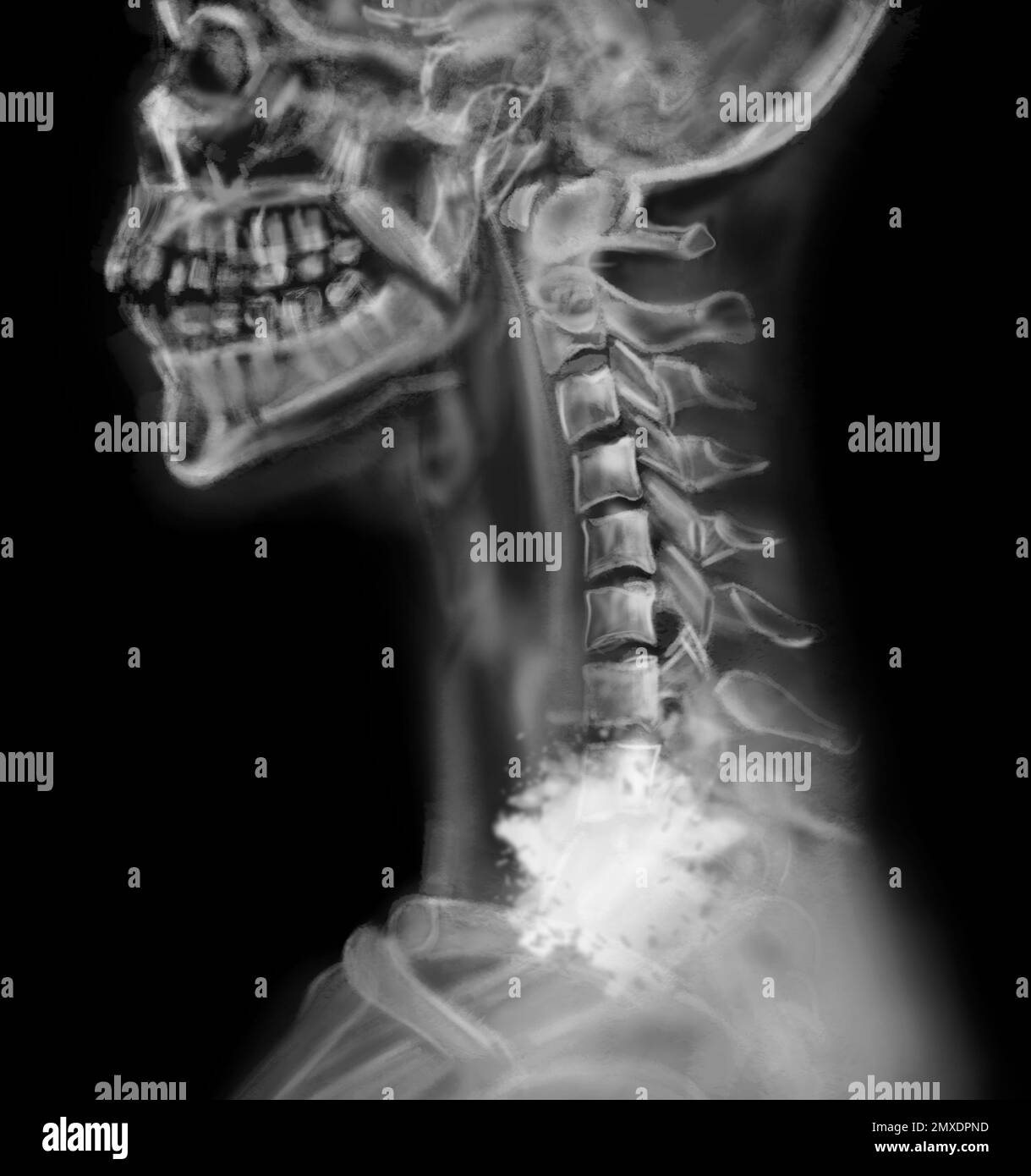 Radiografia di un paziente affetto da cancro. Illustrazione Foto Stock