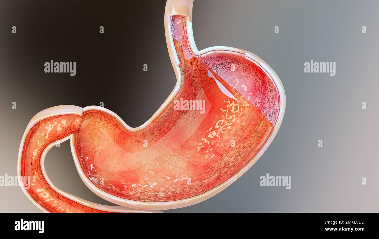 Relux acido dello stomaco. Esofago, gerd. Dolore all'apparato digerente, gastrite, pirosi, organo del corpo umano, resa 3D Foto Stock