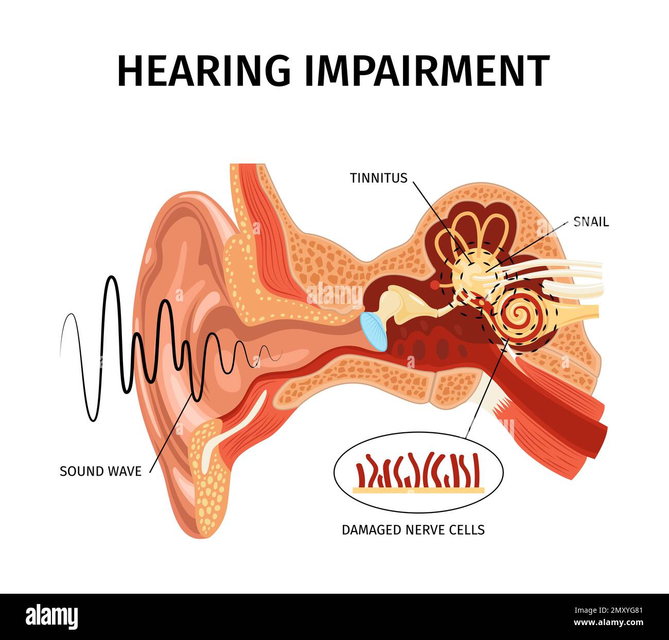 Anatomia realistica composizione del tinnito dell'orecchio con vista sonora degli organi interni con puntatori e didascalie di testo modificabili illustrazione vettoriale Illustrazione Vettoriale