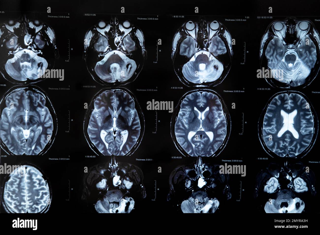 rm con tumore cerebrale. Imaging a risonanza magnetica. Foto Stock