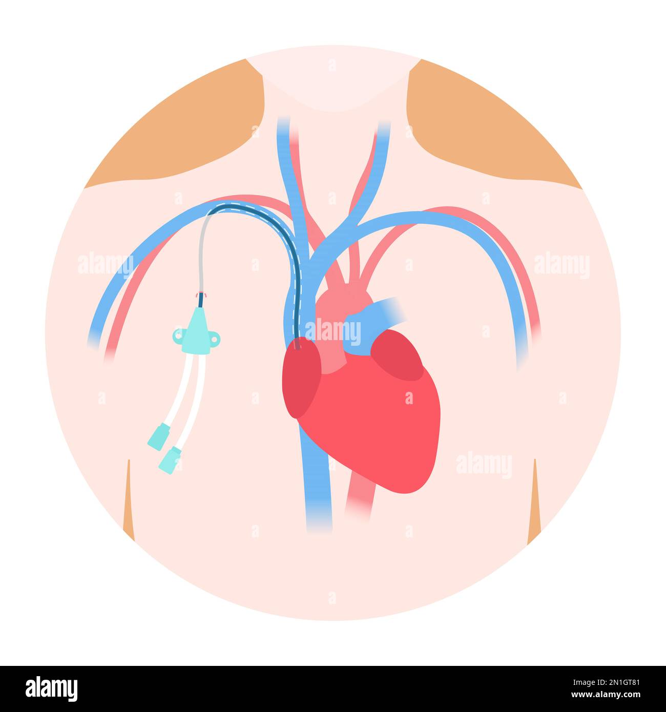 Diagramma medico del catetere venoso della linea centrale con tunnel Illustrazione Vettoriale