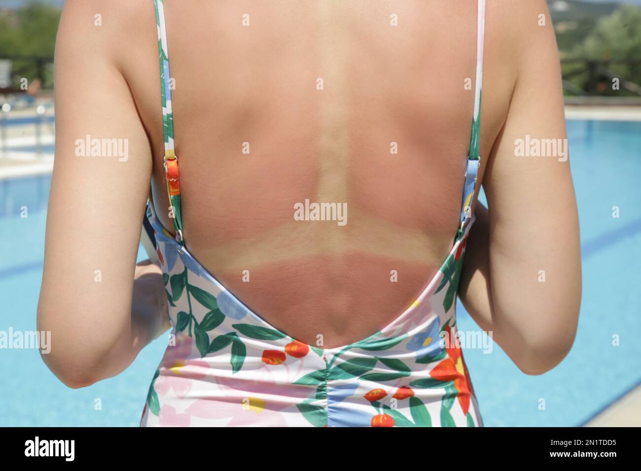 Concetto di scottatura solare e cura della pelle. Giovane donna con pelle rossa incendiata sulla schiena in piscina. Foto Stock