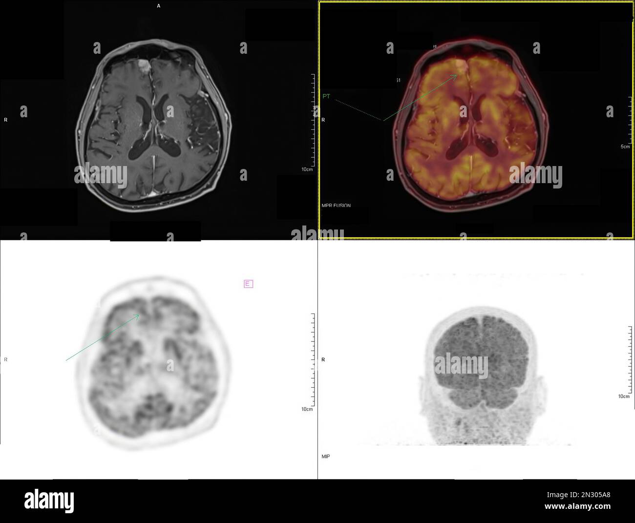 Tomografia A Emissione Di Positroni Tipo La tomografia a emissione di positroni (PET) CT scan utilizza un