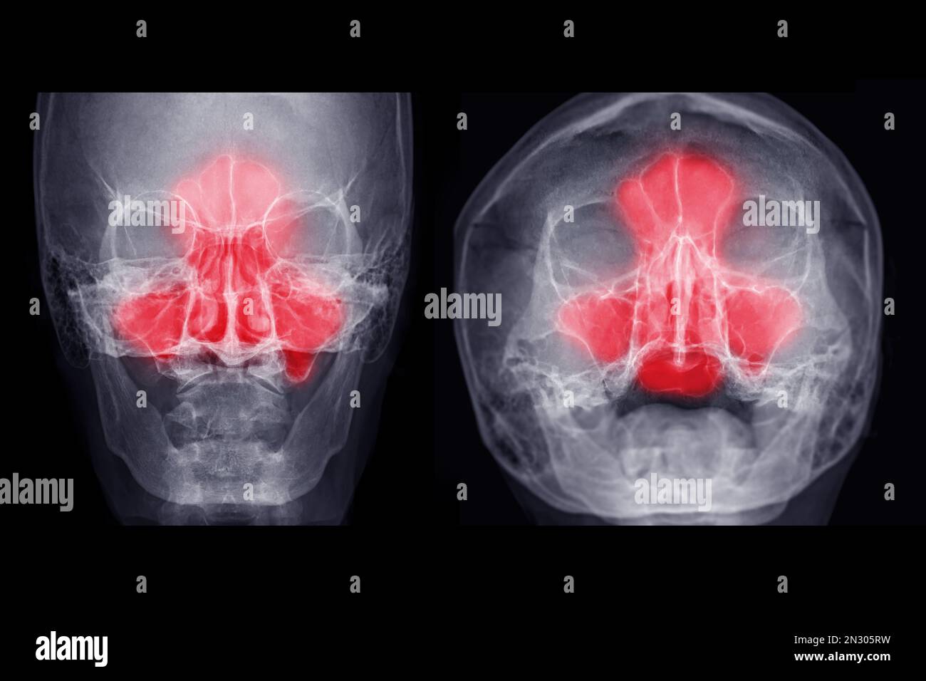 Immagine radiografica dei seni paranasali AP e vista dell'acqua per diagnosi sinusite. Foto Stock