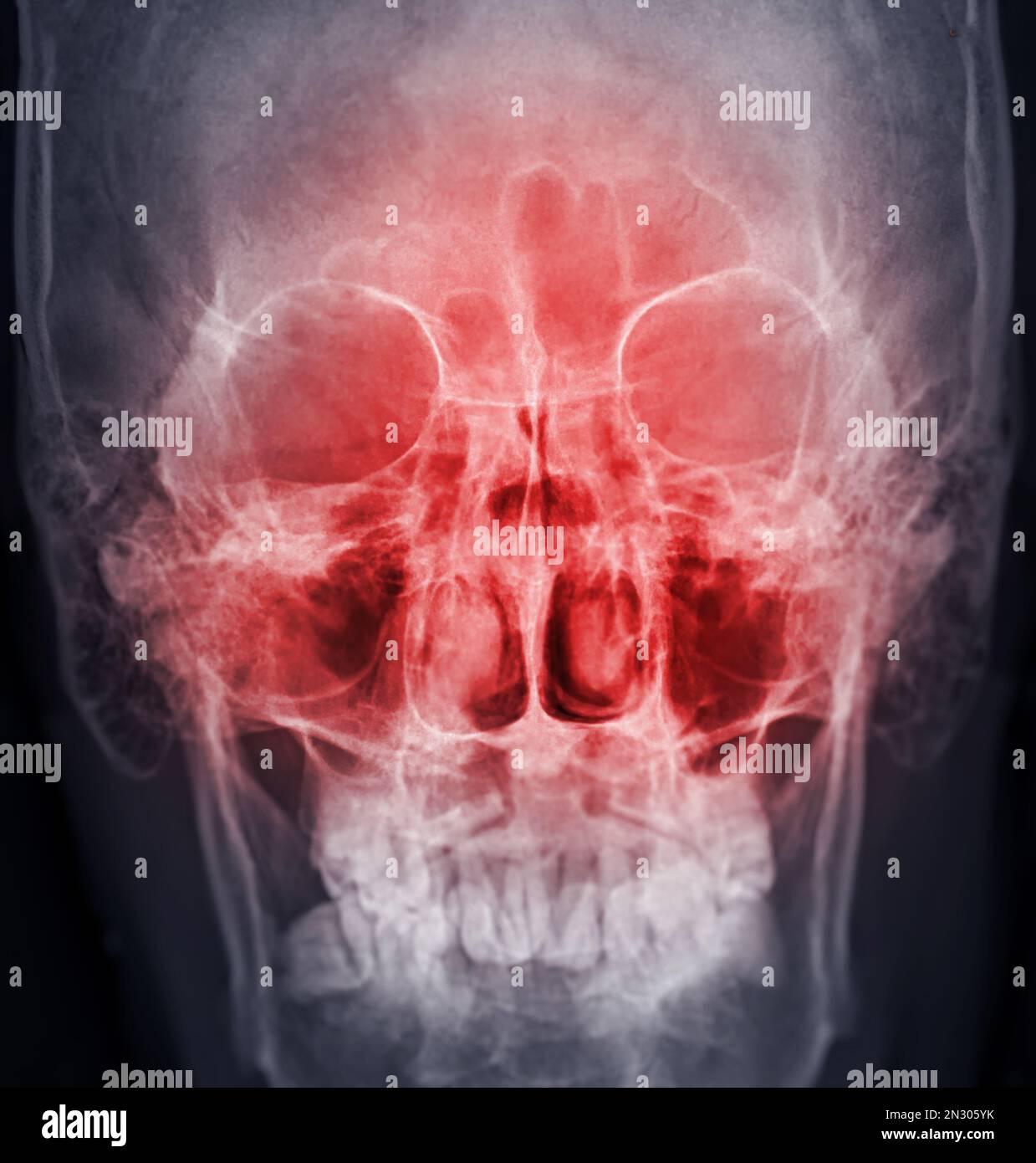 immagine radiografica dei seni paranasali per diagnosi sinusite. Foto Stock