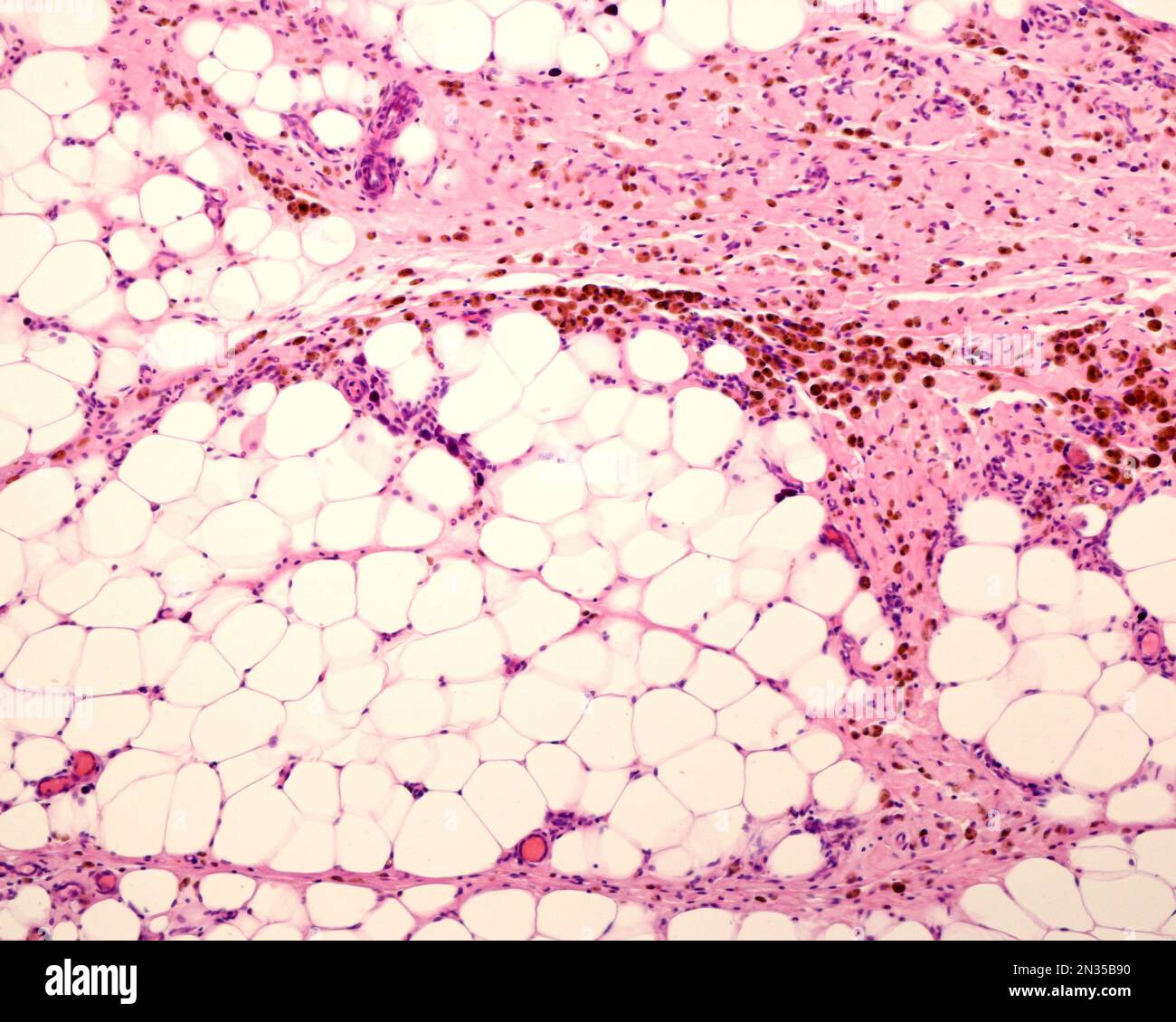 Grasso peritoneale che mostra macrofagi marcati con ferro colloidale. Il ferro colloidale può essere utilizzato come colorante vitale per marcare i macrofagi. Colloidale circolante Foto Stock