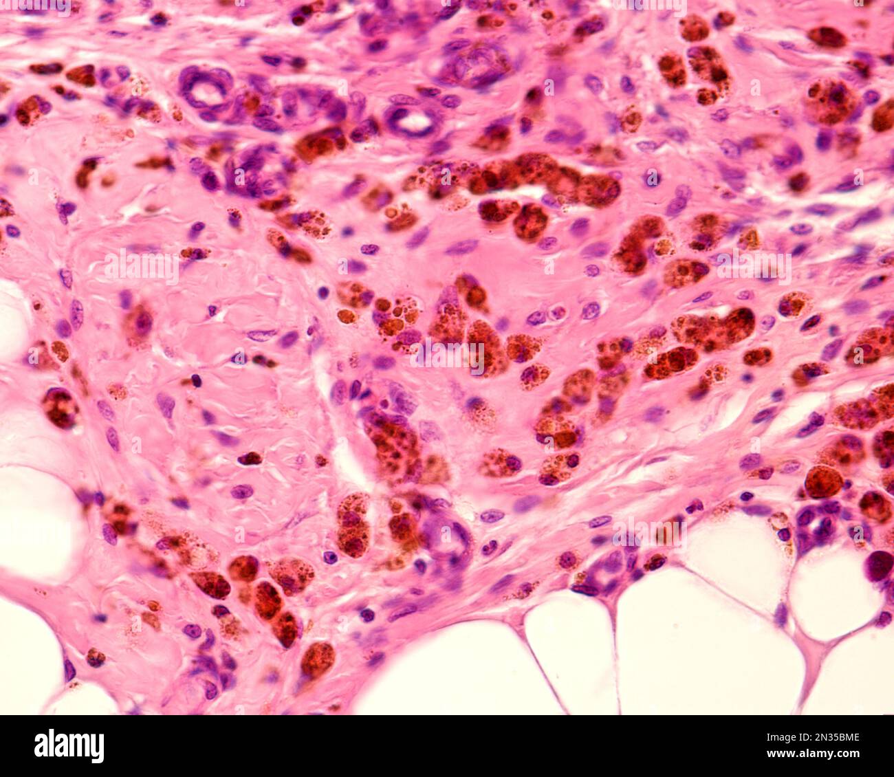 Grasso peritoneale che mostra macrofagi marcati con ferro colloidale. Il ferro colloidale può essere utilizzato come colorante vitale per marcare i macrofagi. Colloidale circolante Foto Stock