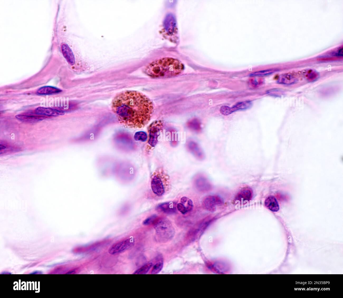 Macrofagi fortemente marcati con ferro colloidale. Il ferro colloidale può essere utilizzato come colorante vitale per marcare i macrofagi. Il ferro colloidale circolante è fago Foto Stock