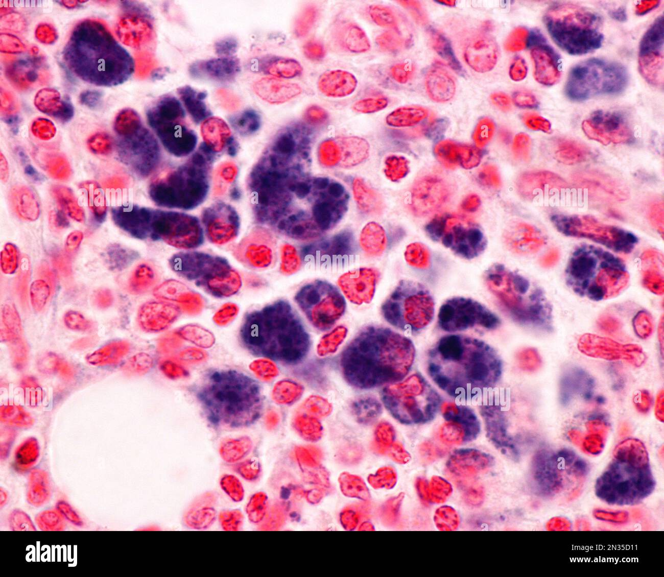 Micrografia ad alto ingrandimento che mostra macrofagi di una zona infiammatoria fortemente marcata con blu Trypan. Il blu tripan è una macchia vitale che può essere in Foto Stock