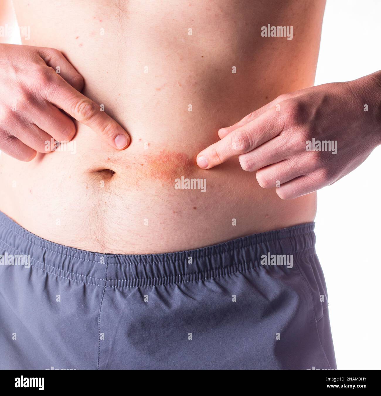 I primi segni di psoriasi o di un'altra malattia della pelle. Foto Stock